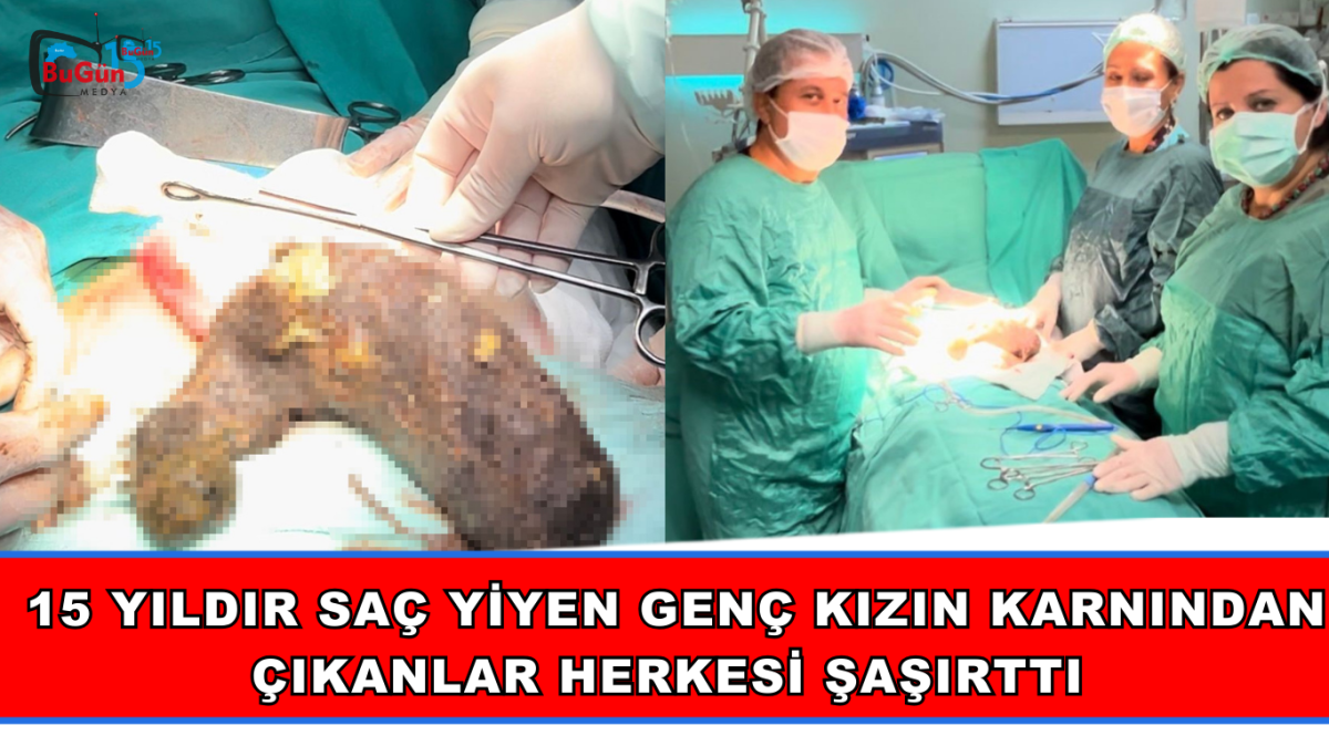 15 YILDIR SAÇ YİYEN GENÇ KIZIN KARNINDAN ÇIKANLAR HERKESİ ŞAŞIRTTI 